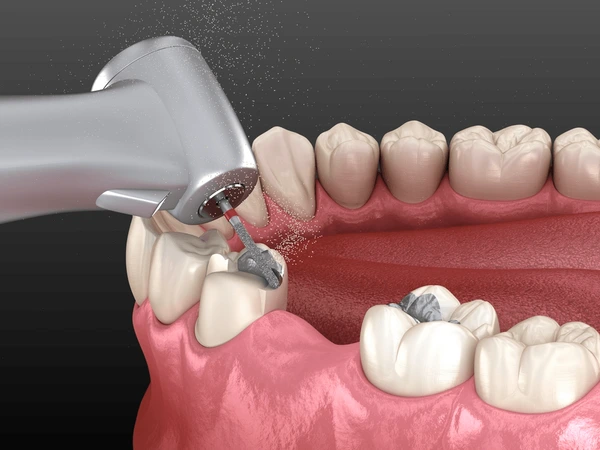 Procedimento de remoção de amálgama com protocolo SMART