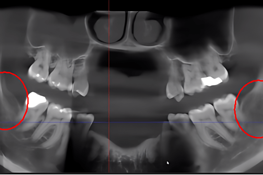 Tomografia mostrando cavitações osteonecróticas no maxilar